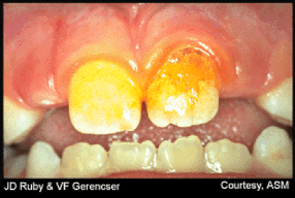 Biofilms are responsible for tooth decay